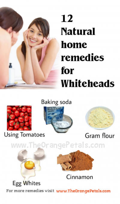 Natural Home remedies for Whiteheads