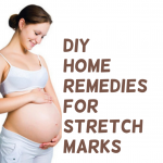 Home Remedies for Stretch marks